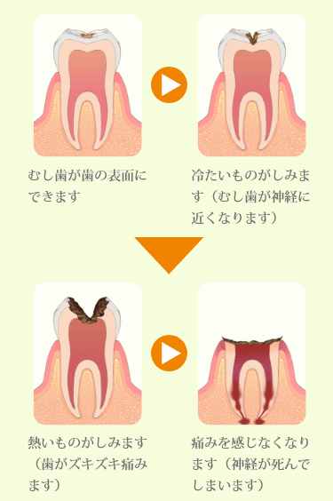 むし歯はこうして進行します