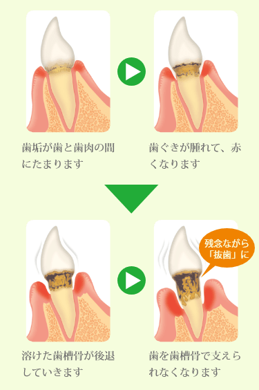 歯周病はこうして進行します