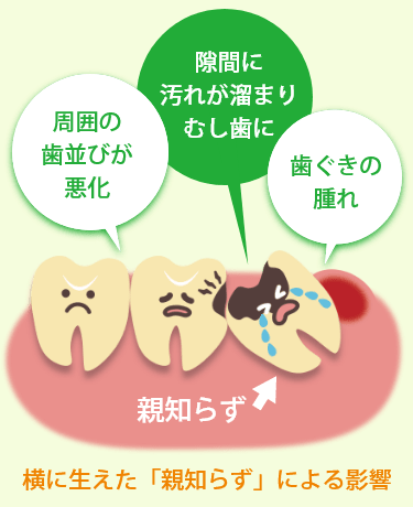 横に生えた親知らずによる影響